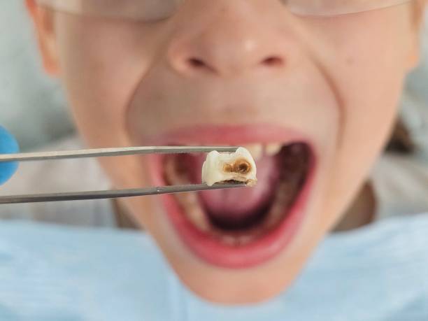 Best Emergency Dentist for Lost Fillings or Crowns in Pleasant Run, OH